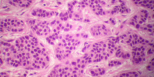 metastatic breast cancer photo