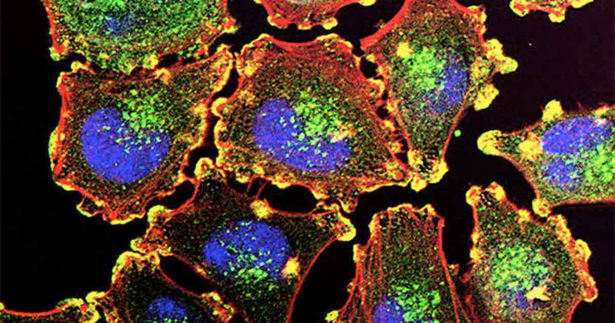 NIH melonoma cells